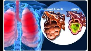 Acute Respiratory Distress Syndrome ARDS [upl. by Ynnatirb]