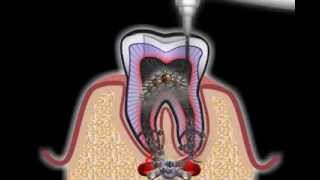 Wurzelbehandlung beim Zahnarzt [upl. by Jariah]