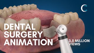 Dental Surgery Animation  Bone Grafting [upl. by Ayota]