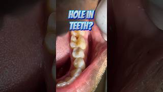 Hole in Teeth Treated with Indirect Restoration [upl. by Niloc]