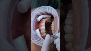 Porcelain veneers for gap teeth veneers dental dentist [upl. by Christianna]