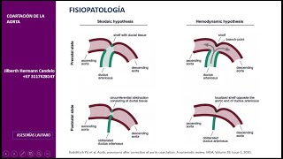 Coartación de aorta [upl. by Holly-Anne]