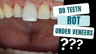 The Truth Behind Teeth Rot under Veneers [upl. by Adnarb497]