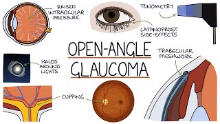 Understanding Open Angle Glaucoma [upl. by Albright770]