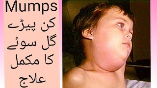 Mumps  Homeo treatment  By DrSohail Janjua [upl. by Anytsirhc46]