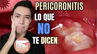 PERICORONITIS  PERICORONARITIS  Pericoronitis MUELA del JUCIO TRATAMIENTO  como se CURA ✔️🦷 [upl. by Marva]