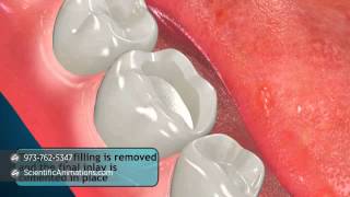 Tooth Restoration Procedures  Inlay [upl. by Tereve]