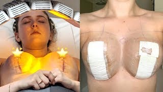 BREAST LIFT RECOVERY WEEK 1  Mastopexy Surgery [upl. by Yevi]