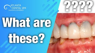 What are the black lines on gums Explained [upl. by Occor]