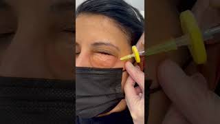 Carboxiterapia facial para las ojeras oscuras [upl. by Amyaj]