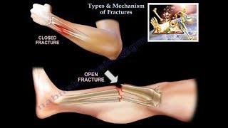 Types amp Mechanism Of Fractures  Everything You Need To Know  Dr Nabil Ebraheim [upl. by Yelloh]