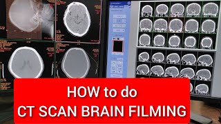 Brain CT scan Filming Protocol [upl. by Demmahum]