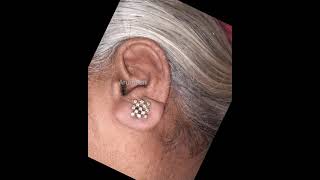 Ear Lobe Repair காது hole சரிசெய்ய permanent treatment at Arumeen Aesthetic Centere DrASaravanan [upl. by Assetal969]