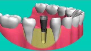 Impianti dentali [upl. by Hagi887]