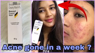 Brevoxyl Cream FaceWash for Rs 139 Review  Benzoyl Peroxide Creamy Wash Review  Somi Singh [upl. by Rorie]