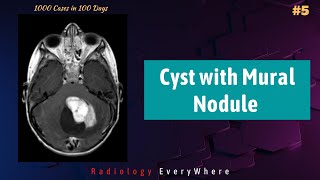 Cyst with a mural nodule  CNS lesions  Radiology cases 1000 cases in 100 days  Case No 5 [upl. by Maclay]