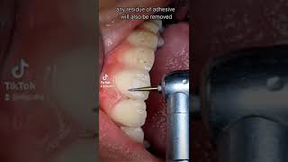 Polishing teeth after bracket removal  Braces Removal [upl. by Hartnett615]