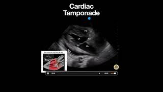 Cardiac Tamponade PSLA [upl. by Thrift]