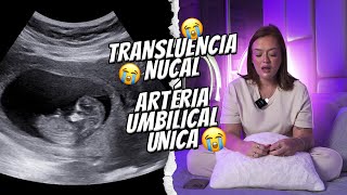 TRANSLUCENCIA NUCAL ALTERADA  ARTÉRIA UNICA UMBILICAL má formação [upl. by Delilah66]