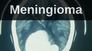 What is a Meningioma Pathology mini tutorial [upl. by Everick533]