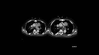 Case of the Week The most likely dx for this mediastinal mass is [upl. by Ahsar]