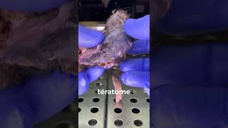 teratome pathologie source extrait video  JAMA [upl. by Roger]