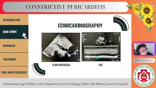 Constrictive pericarditis [upl. by Bentley978]