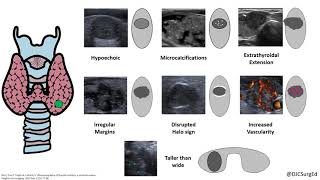 Thyroid Nodules [upl. by Rush]