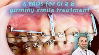 gummy smile amp Cl 2 treatment using IZC amp frontal TADs Mini screw insertion power chain installation [upl. by Lemmor]