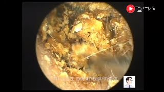 Removal of external auditory canal cholesteatoma by ear endoscopy 19 minutes [upl. by Annorah]