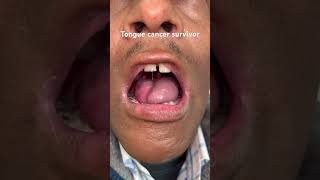 Infrahyoid myocutaneous flap for tongue reconstruction surgery performed for tongue cancer [upl. by Yojal]