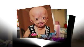 Youtuber Adalia Rose Texas star dies at 15 from rare medical condition [upl. by Whelan]