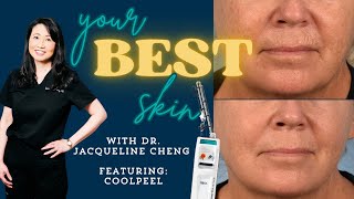 💖 Your BEST Skin 💖 with Dr Jacqueline Cheng ft The CoolPeel Laser ❄️ [upl. by Ahsiei]