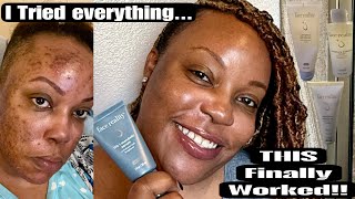 How I Cleared My Acne for Good Skincare Journey amp Best Tips [upl. by Claus]