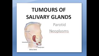 ENT Tumors of Salivary Glands Parotid Neoplasms Benign Malignant Pleomorphic Warthin Cylindroma [upl. by Aneahs828]