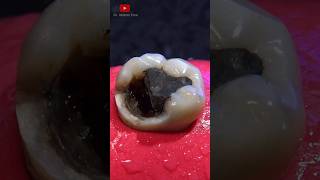 Indirect dental restoration satisfying [upl. by Deina]