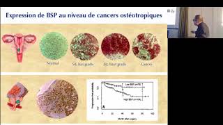 CANCER et Métastases osseuses par Vincent Castronovo [upl. by Atkins112]