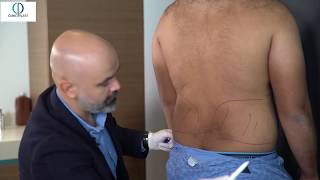 ClinicPlast  Op Dr Salih Onur Basat  Erkeklerde Vaser Liposuction ve Jinekomasti [upl. by Derayne327]