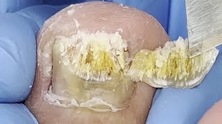 The whole process of nail fungus repair toenail health【Xue Yidao】 [upl. by Amsirac]