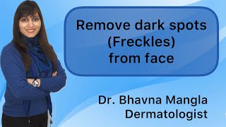 How to Get Rid of Freckles or Brown Spots  Freckles  Dark Brown Spots [upl. by Eniawed996]