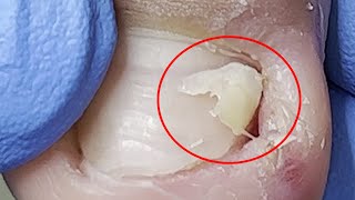 Huge ingrown nails amp toenails heal quickly【Xue Yidao】 [upl. by Ehtylb164]