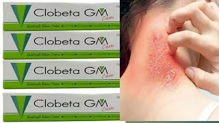 Clobeta gm cream uses in telugu best cream for skin allergy in telugu [upl. by Leinod]