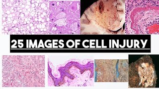 25 Images From Cell Injury  Part 01  Made Easy [upl. by Ahsaeyt]