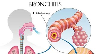 BRONHITISI medicina inflamacion mjekesi mushkerit bronchitis [upl. by Errecart797]