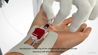 MEDBAR  Arterial Cannula [upl. by Gilliam]