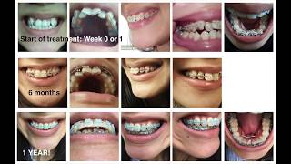 Adult braces timelapse 1 year [upl. by Drarig]