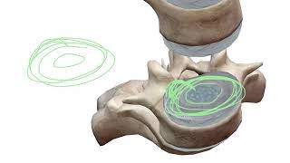 Disc Herniation  What is a Disc Protrusion vs Disc Extrusion [upl. by Ynaffi906]