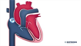 Sistema Elétrico do Coração  Animação Médica [upl. by Attekram]