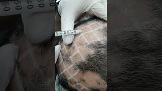 Demo19 Intralesional triamcinolone for alopecia areata [upl. by Cummins]