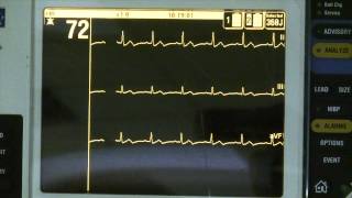 Normal Sinus Rhythm [upl. by Arvad]